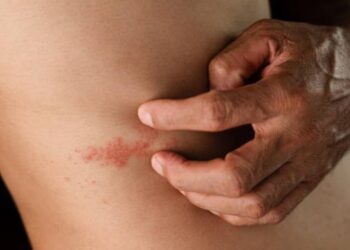 Ausschlag am Oberkörper