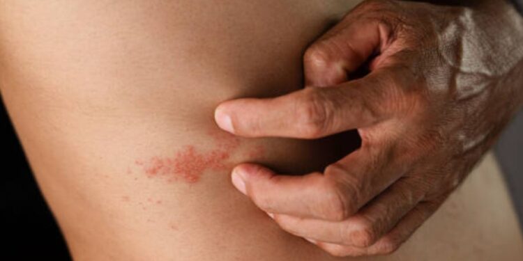 Ausschlag am Oberkörper